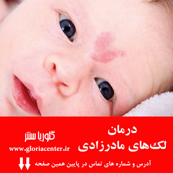 درمان لک های مادرزادی