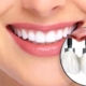ایمپلنت دندان در ایران