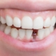 دوره نقاهت ایمپلنت دندان چگونه است؟