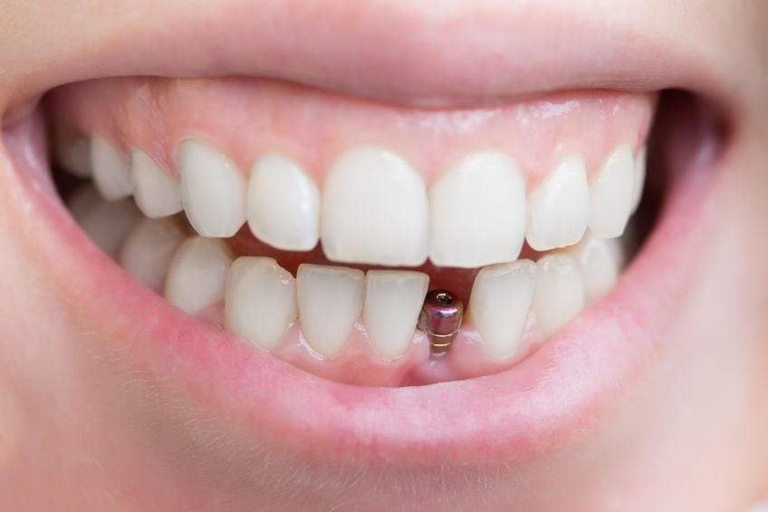 دوره نقاهت ایمپلنت دندان چگونه است؟