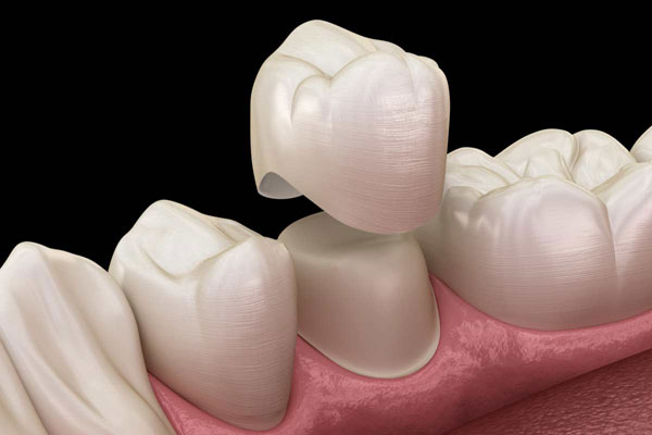 تفاوت ایمپلنت دندان و روکش