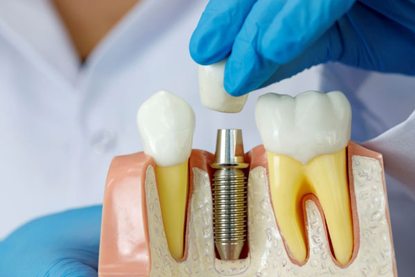 تفاوت ایمپلنت دندان و روکش
