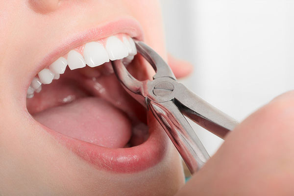 فاصله بین کشیدن دندان و ایمپلنت