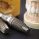 انواع برند ایمپلنت دندان