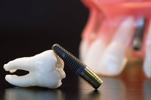 لق شدن ایمپلنت دندان