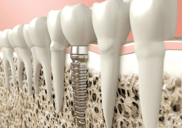 ایمپلنت دندان چقدر طول میکشد؟
