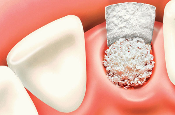ایمپلنت دندان چقدر طول میکشد؟