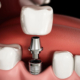 تفاوت ایمپلنت دندان و بریج، کدام بهتر است؟