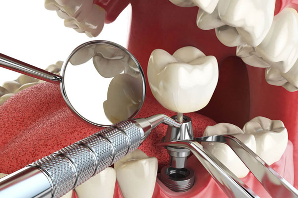 آیا ایمپلنت دندان باعث سرطان میشود