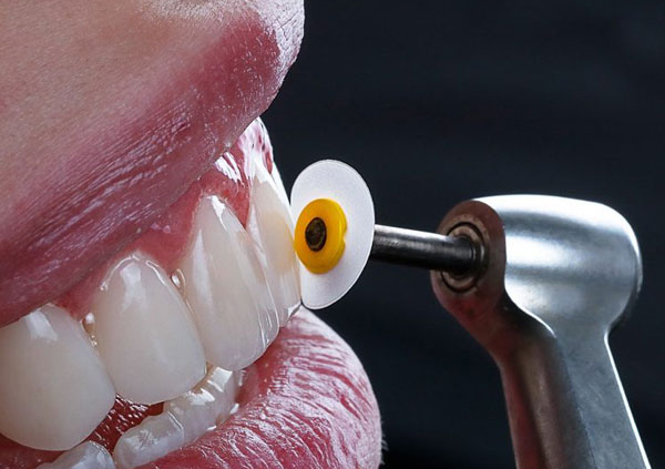 آیا در کامپوزیت هم دندان تراش داده می شود ؟