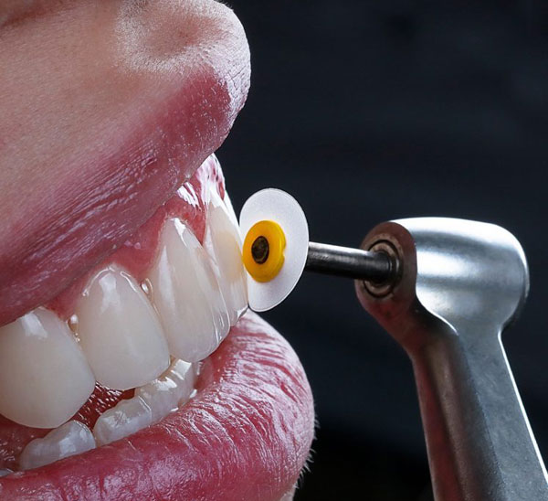 آیا در کامپوزیت هم دندان تراش داده می شود ؟