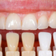 کامپوزیت دندان چگونه نصب می شود؟