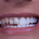 کامپوزیت دندان برای چه دندان هایی مناسب است