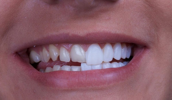 کامپوزیت دندان برای چه دندان هایی مناسب است