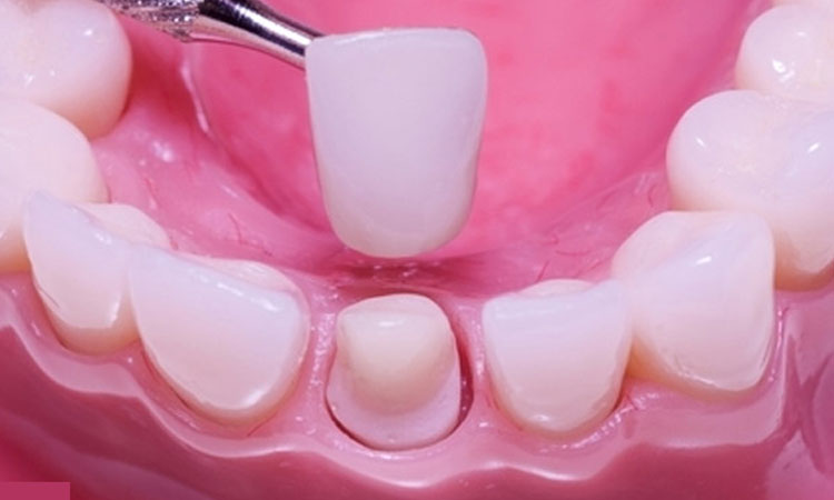 کامپوزیت دندان چقدر طول می کشد