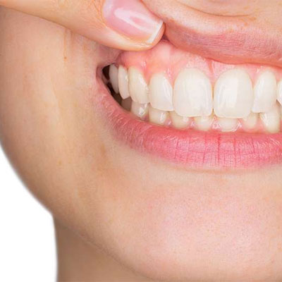 طول عمر کامپوزیت دندان به چه مواردی بستگی دارد؟