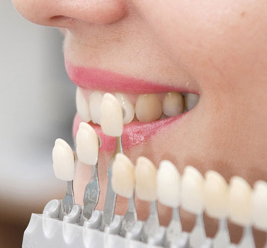 کامپوزیت دندان برای چه کسی مناسب است؟