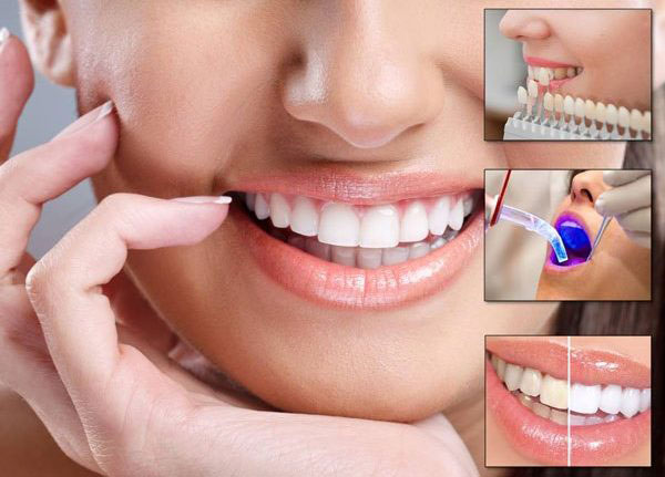 کامپوزیت دندان برای چه کسی مناسب است؟