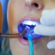 آیا کامپوزیت دندان تغییر رنگ می دهد؟