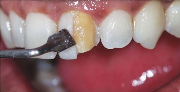 آیا کامپوزیت دندان تغییر رنگ می دهد؟