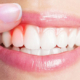 آیا کامپوزیت دندان عوارض دارد؟